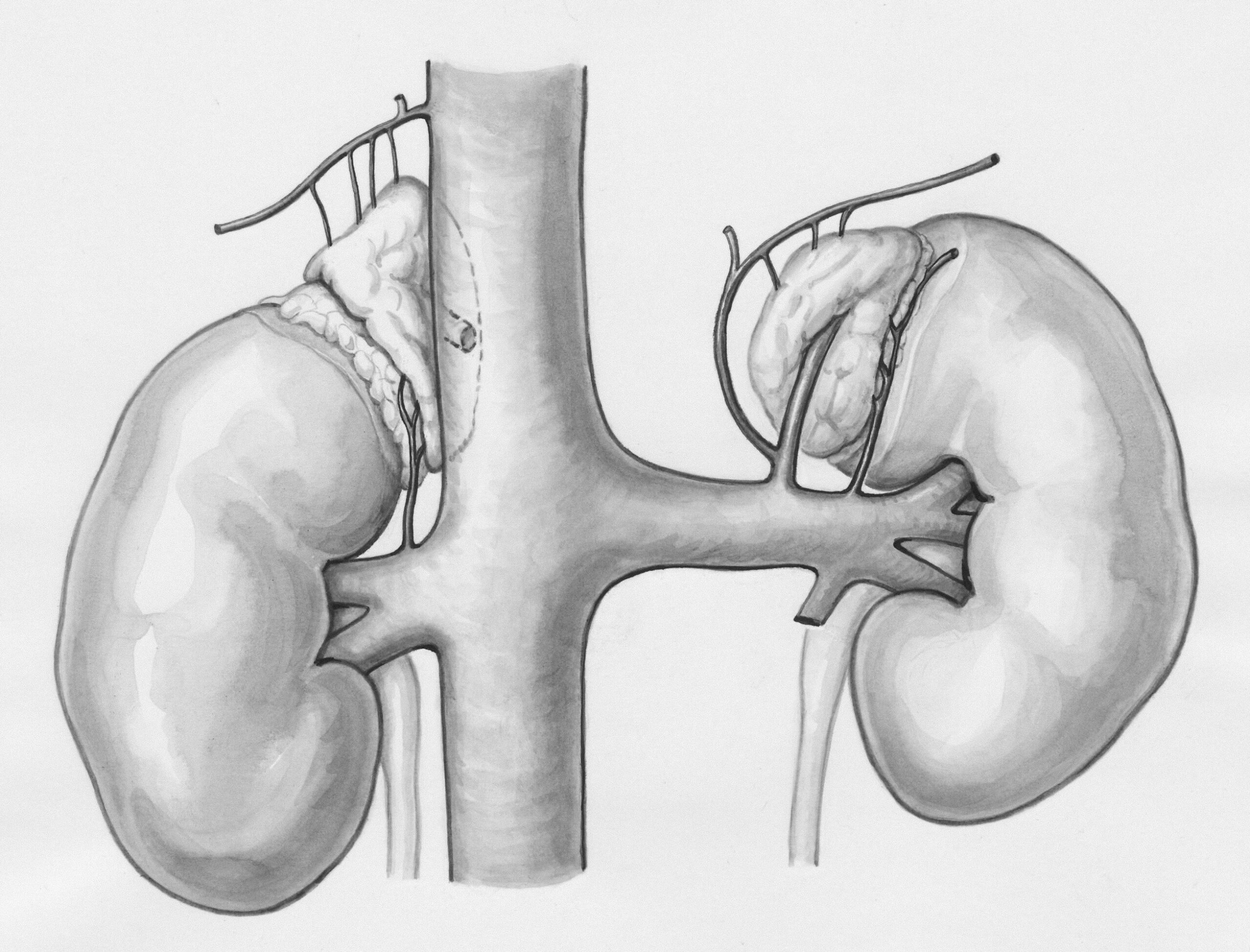 Recognizing Symptoms of Hydronephrosis in Adults